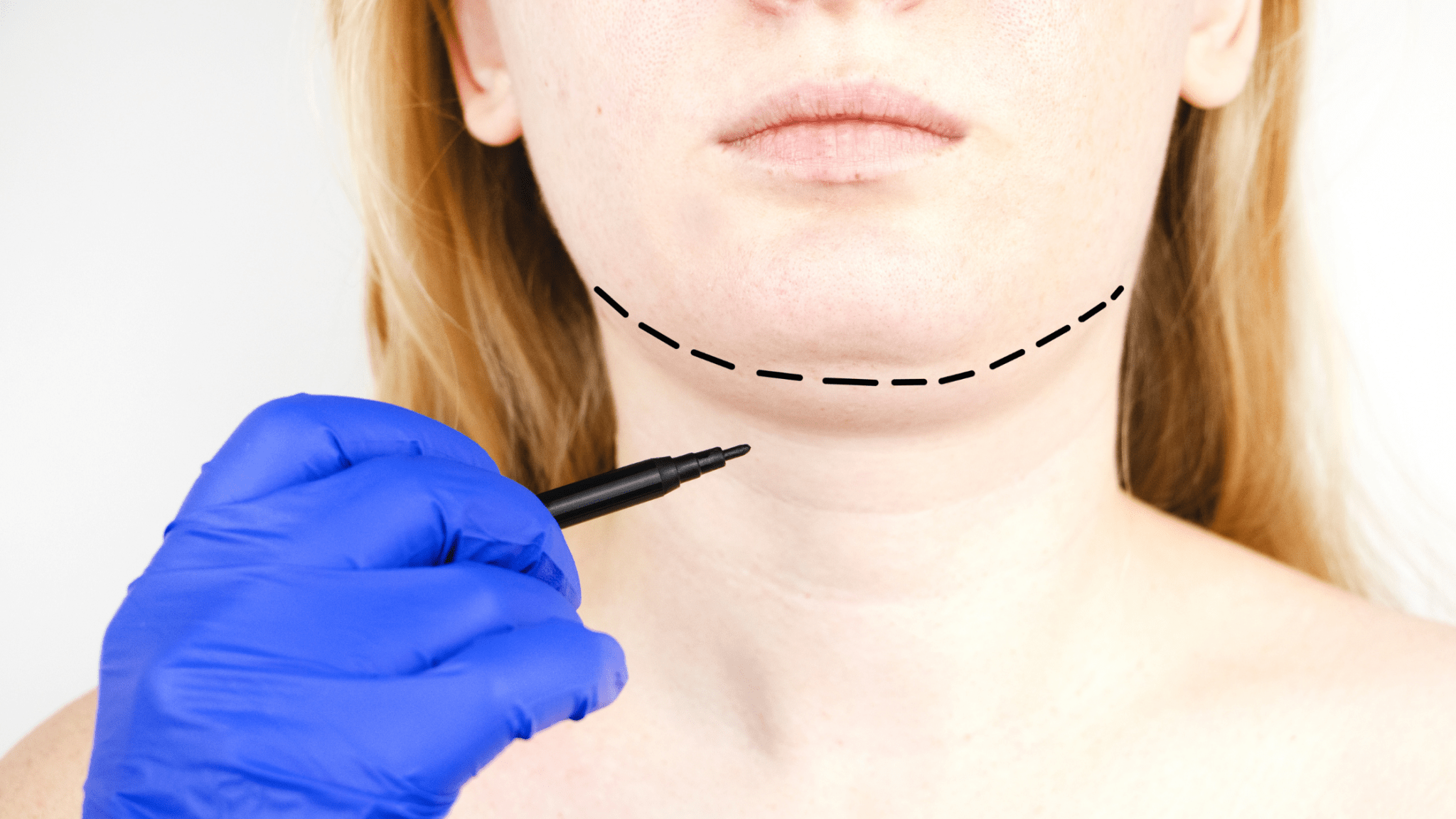 THE RISE OF THE “CHIN BBL